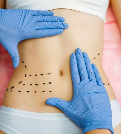 lipoescultura-colombian-medical-care